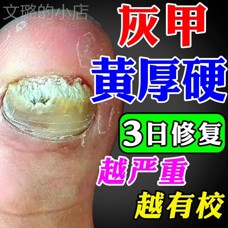 脚指甲发黄变厚坏指甲增厚脚趾甲黄黑白空甲修复甲分离灰甲神器药