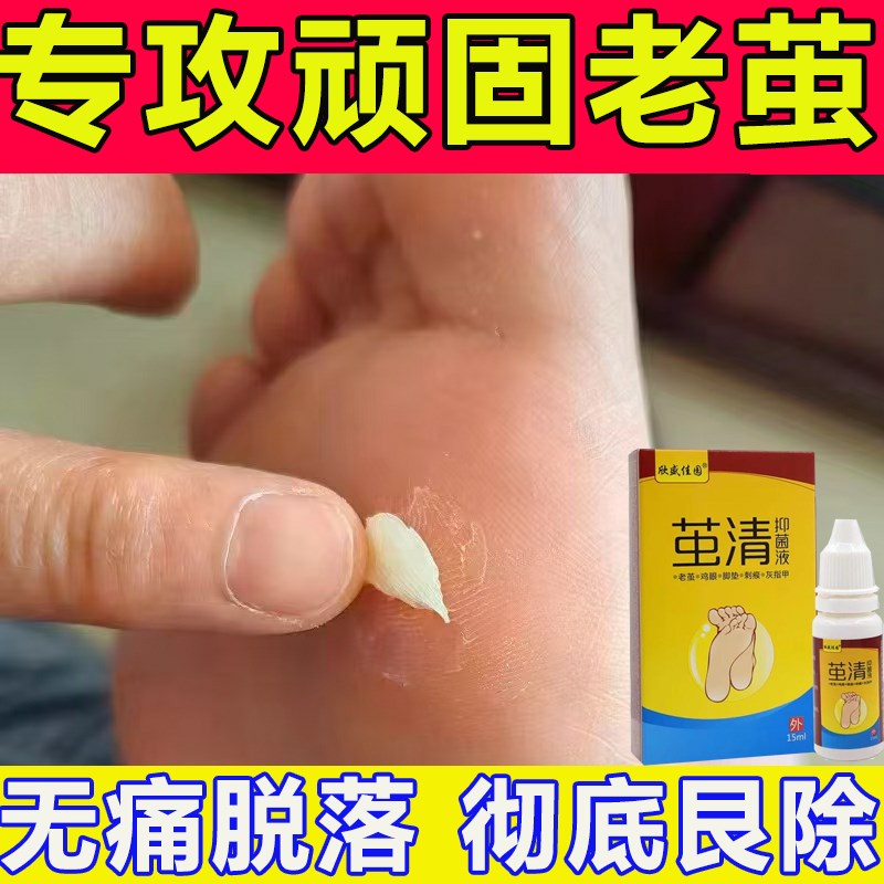 去老茧脚底脚垫厚茧鸡眼膏脚后跟脚掌死皮硬皮脚趾关节茧去茧神器