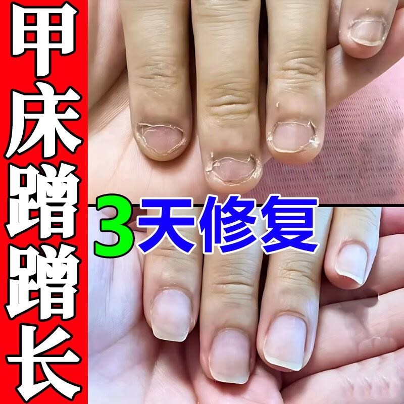 甲床修复生长液啃咬指甲受损萎缩再生甲肉分离空甲断裂护甲油增长