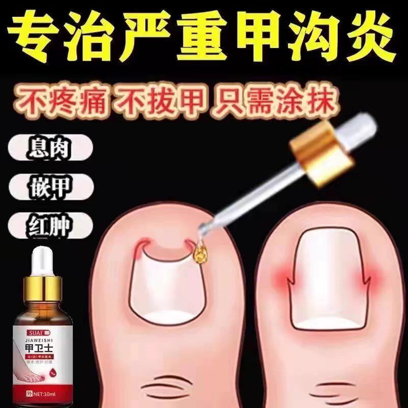 【严重甲沟炎专用】去肉芽脚趾甲往肉里长嵌甲红肿疼痛化脓抑菌液