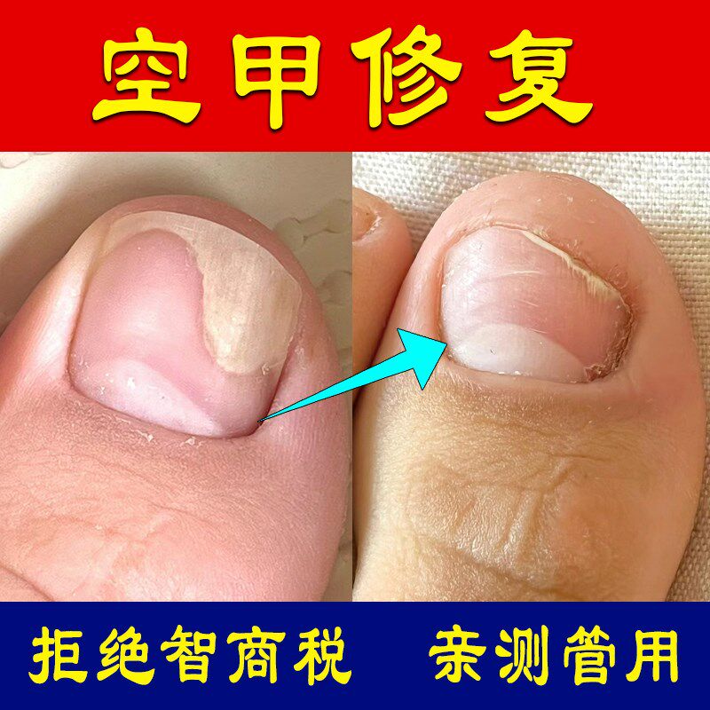 冶甲床甲肉分离空甲修复液指甲受损专用分层竖纹剥离凹凸不平油