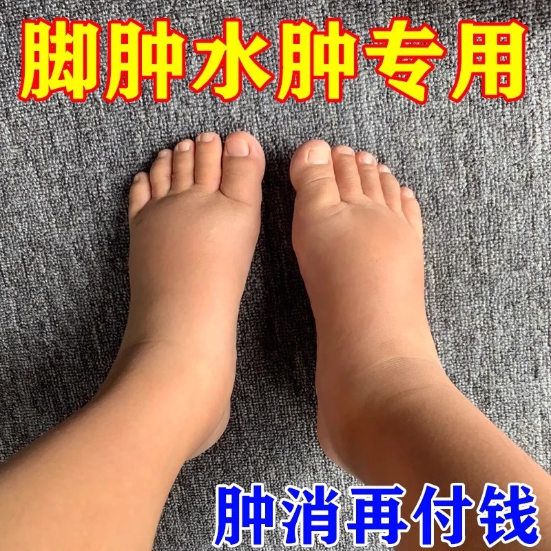 【200%消水肿】利尿排水肿去肿老人下肢浮肿脚肿脸肿全身消水肿贴