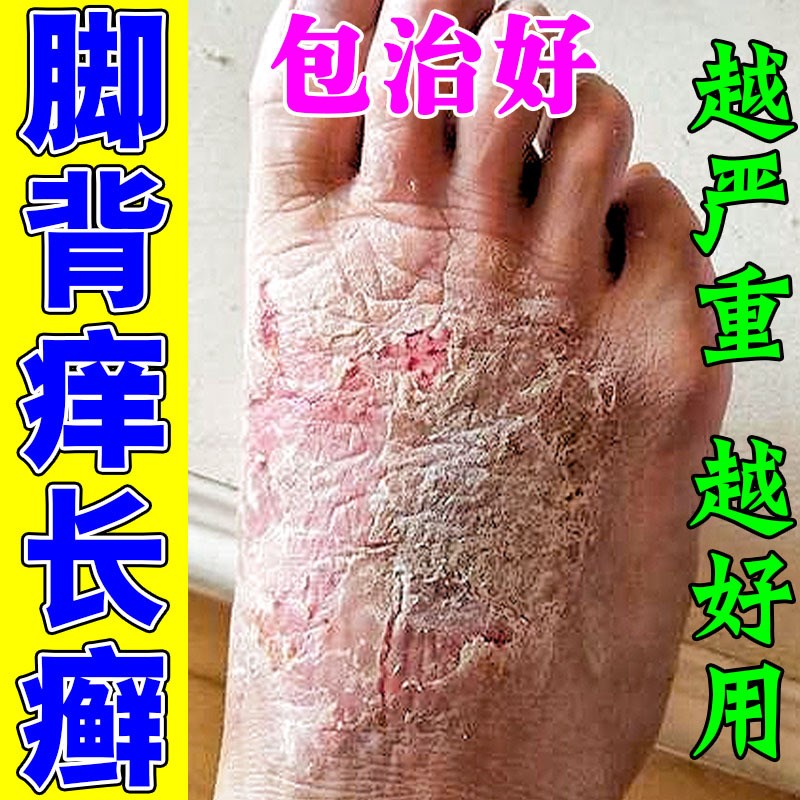 脚背上长癣脚杆痒真菌感染起皮顽固性皮炎脚背发痒长癣红肿痒药膏