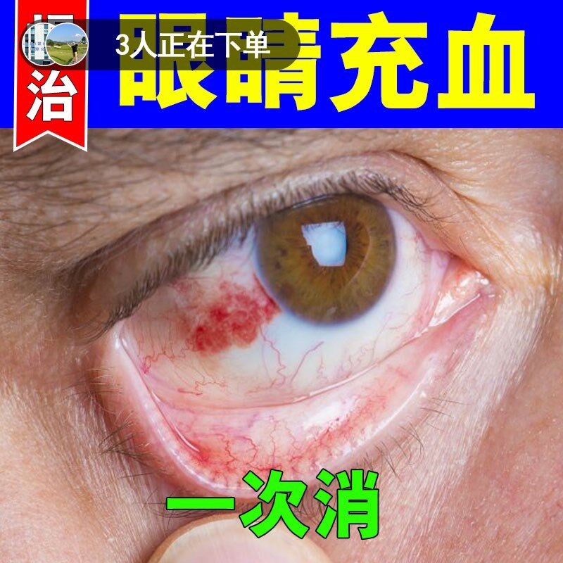 眼底充血眼水眼睛充血淤血红血丝视物模糊眼有异物感黄斑纯草本