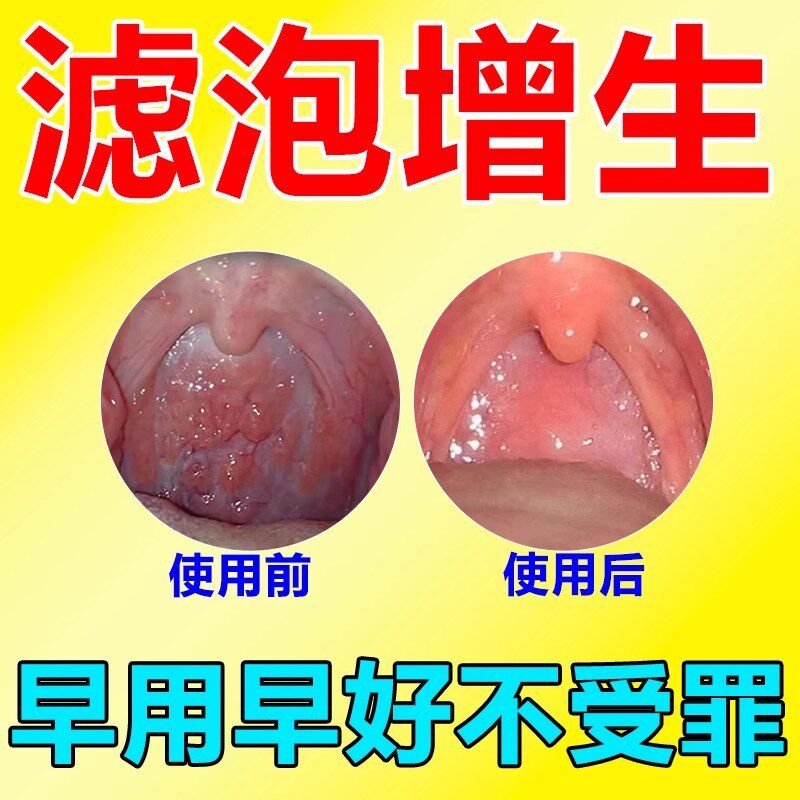 喉咙滤泡增生咽喉焱淋巴滤泡舌根滤泡干痒咳嗽咽喉肿有痰有异物感