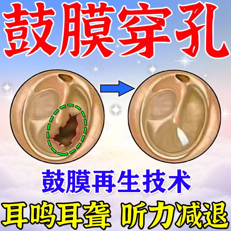 鼓膜非耳塞耳膜--穿孔中耳滴耳液外耳道红肿耳闷耳堵耳鸣眩晕流脓