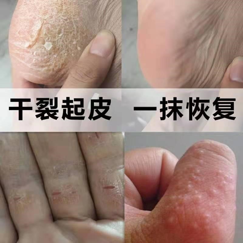 手起小水泡手痒水泡脱皮干裂苗医药膏手脱皮季节性止痒去痒皮肤痒