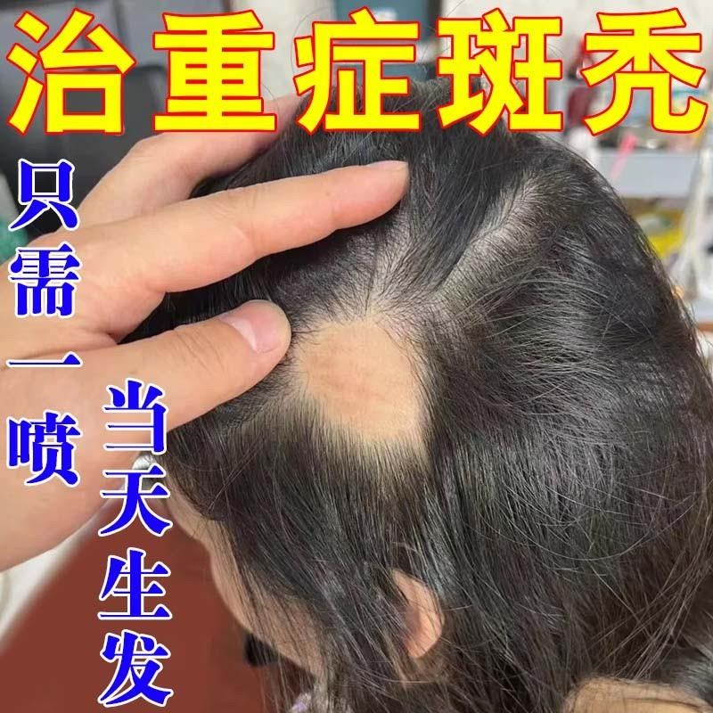 斑秃鬼剃头快速生发严重掉发秃顶突发性斑秃非瘢痕性防脱预发专用