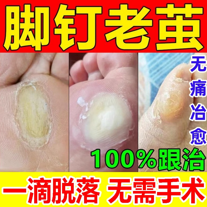 脚钉祛除膏去除厚脚垫老茧死皮根去脚底板脚掌趾指头硬皮软化剂药