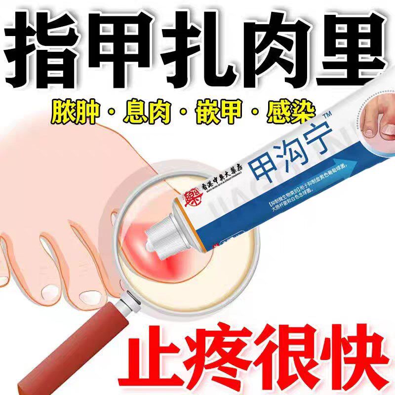 甲沟炎专用软甲嵌甲去肉芽脚趾矫正器灰指甲软化息肉抑菌去除药膏
