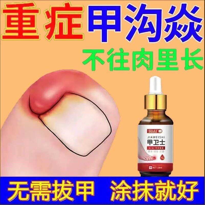 甲卫士专治甲沟炎痛神器肉芽化脓红肿嵌甲走路疼草本镇痛抑菌药水