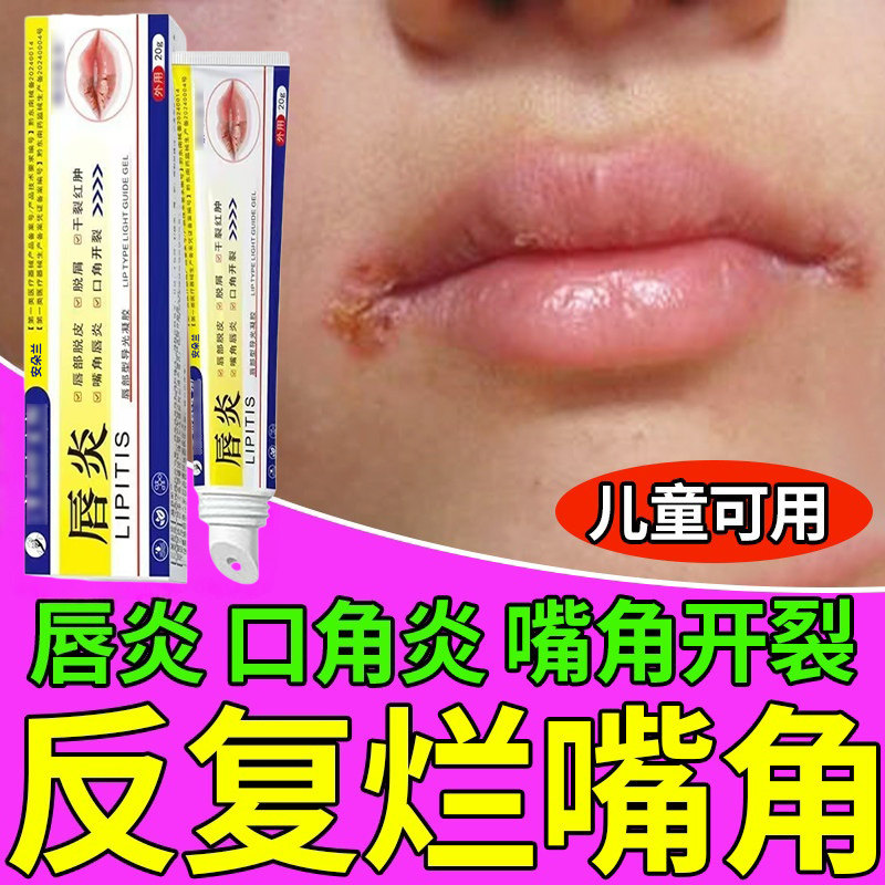 口角炎烂嘴角膏药贴专用唇膏嘴角开裂口儿童嘴角疱疹红肿唇炎WW