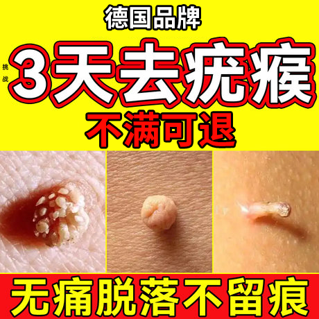 【德国品牌】疣瘊专用膏