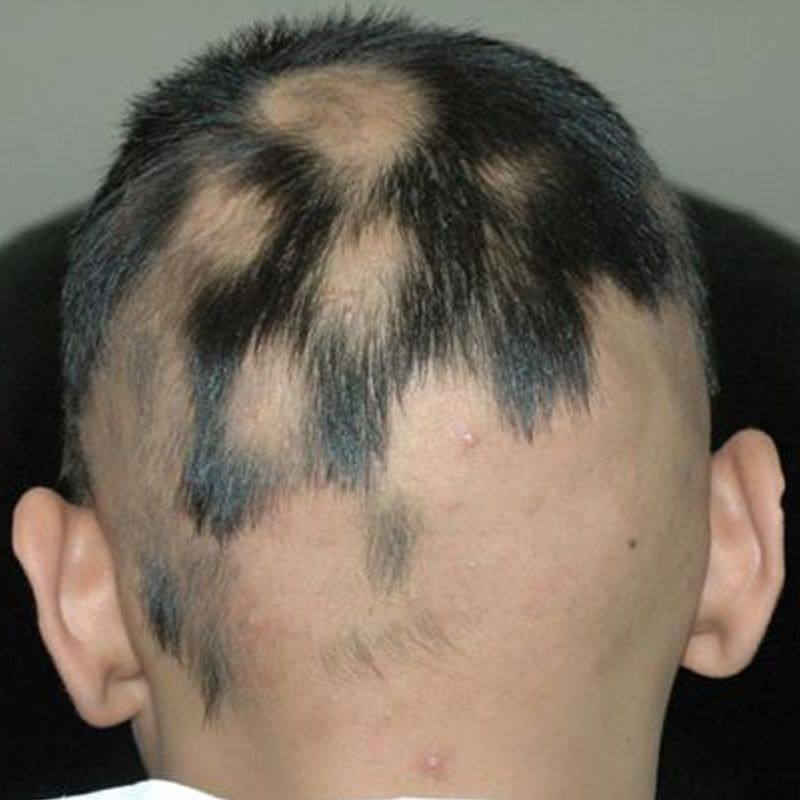 儿童后脑勺突发性斑片状脱发严重斑秃油脂性脱发治鬼剃头快速生发