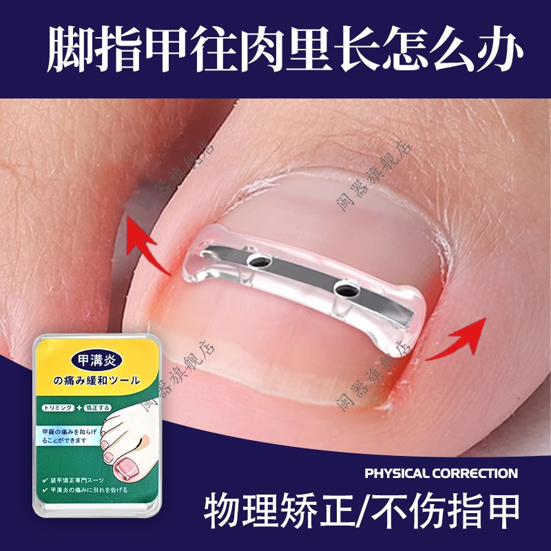 脚指甲往肉里长怎么办甲沟炎嵌甲矫正器卷甲脚趾甲盖正甲贴垫片