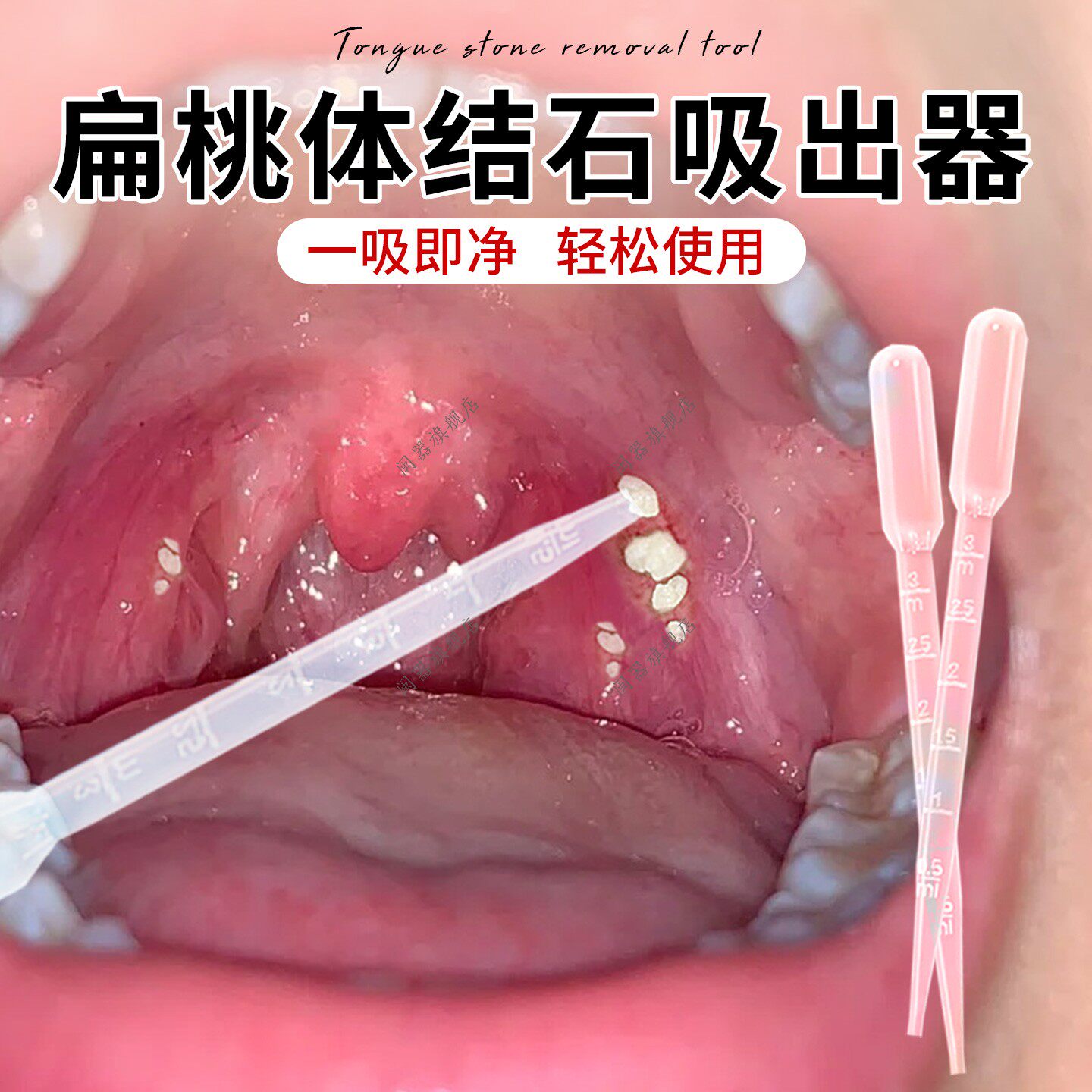 扁桃体结石吸出器结石去除工具口腔扁条体扁桃腺扁导体石清理器 - 实物图