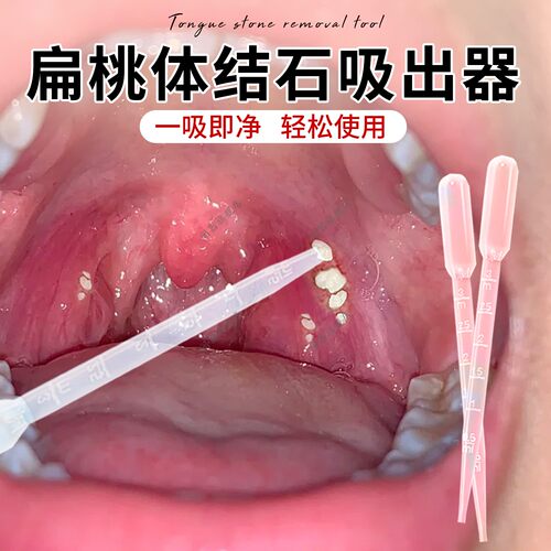 扁桃体结石吸出器结石去除工具口腔扁条体扁桃腺扁导体石清理器