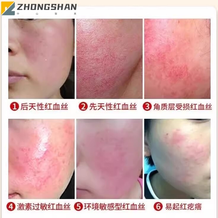 激素脸修护霜改善敏感肌泛红去红血丝增厚角质层保湿积雪草修复霜