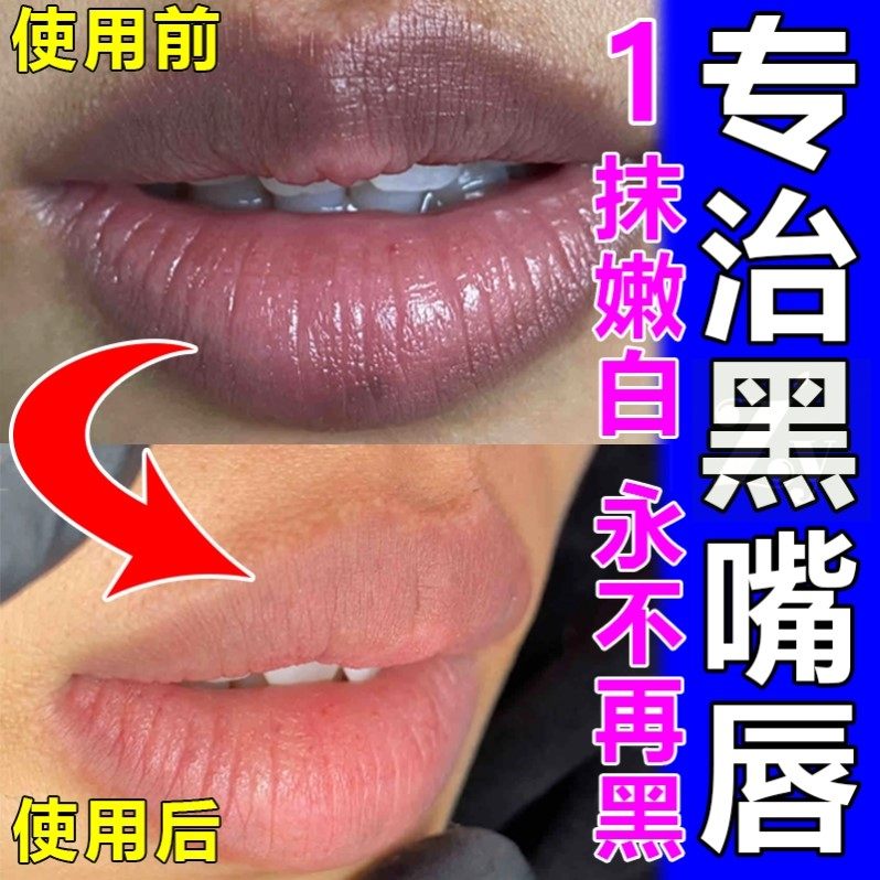 嘴唇发黑发紫去除嘴巴周边暗沉黑色素改善专用膏修复淡化唇部色纹