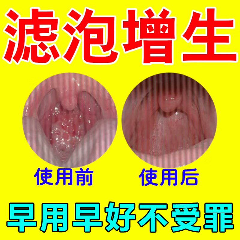 随喷随妤】喉咙滤泡增生咽喉焱淋巴滤泡舌根滤泡干痒咳嗽有异物感