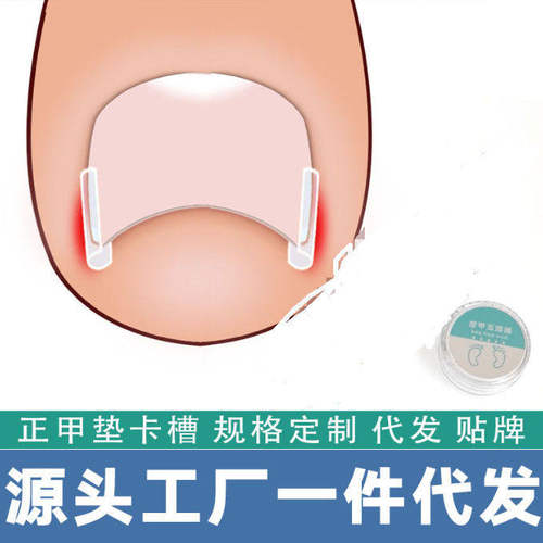 甲沟矫正器嵌甲神器防脚指甲填充垫片炎治疗辅助工具实用有效