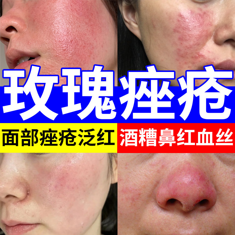 藤石制药红血丝玫瑰痤疮屏障修复专用酒渣鼻软膏护肤品药房同售WQ