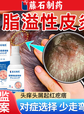 头皮脂溢性皮炎真菌感染喷雾剂