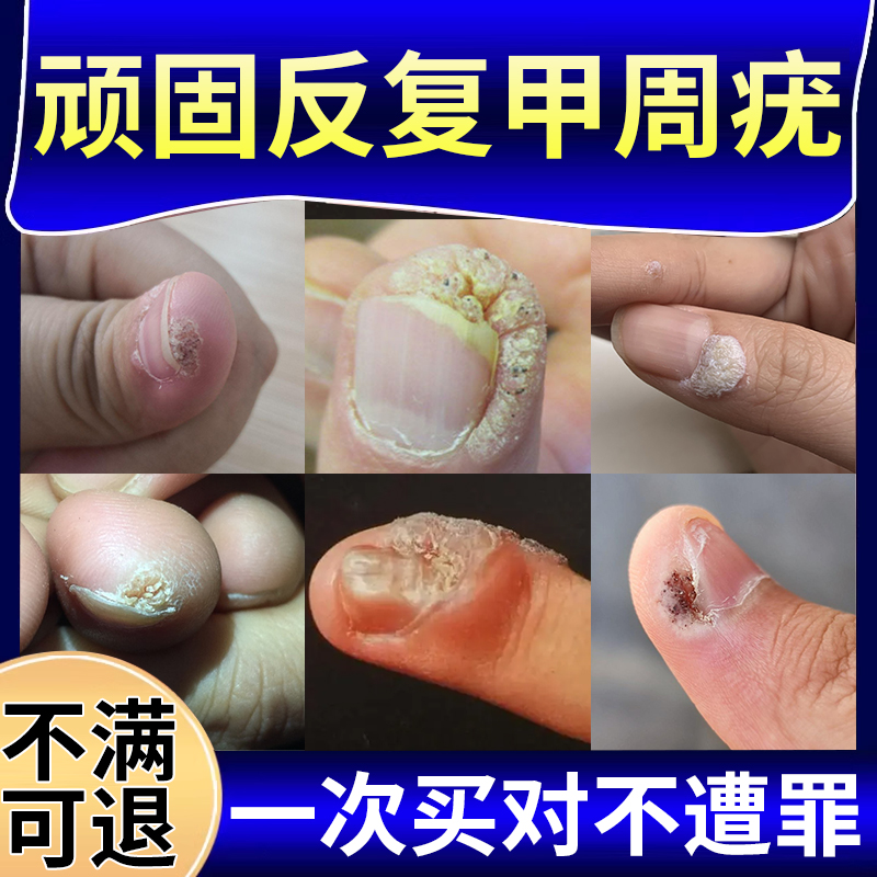 手上长疣甲下疣甲周疣专用寻常疣祛去除神器可搭配祛疣灵膏药膏to