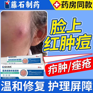 脸上疖肿结节硬块痘痘起硬疙瘩红肿毛囊炎痤疮火疖子囊肿脓包型WQ