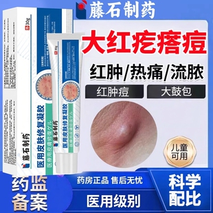 皮脂腺囊肿疖肿拔毒膏皮下粉瘤结节痘痘红肿火疖子乳膏HT