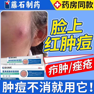 脸上疖肿结节硬块痘痘起硬疙瘩红肿毛囊炎痤疮火疖子囊肿脓包型WQ