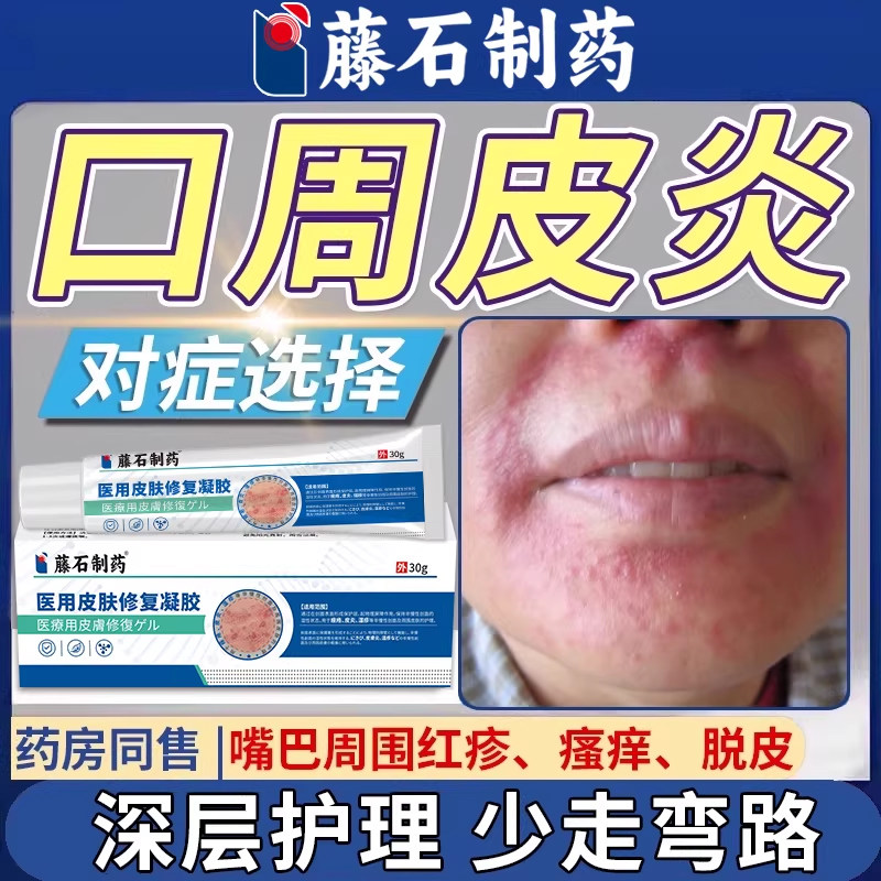口周皮炎专用嘴巴周围丘疹瘙痒过敏嘴角干燥起皮唇周药房同售膏WQ