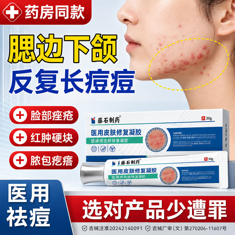 下颌线淋巴痘腮边痘专用下巴反复长痘痘消炎红肿硬块祛痘痤疮膏TU
