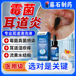 霉菌性耳道炎耳朵痒中耳炎真菌感染内外耳道湿疹清洗液抑菌医用TU