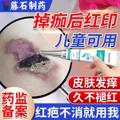 伤口结痂脱落后紫红黑印