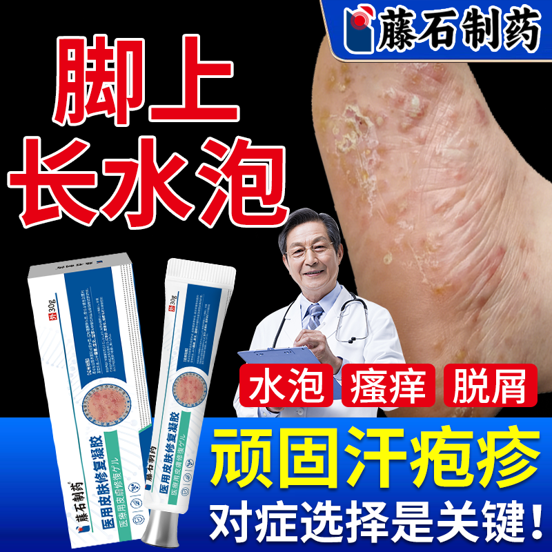 脚上汗泡疱疹去脚底起小水泡又痒又脱皮瘙痒根止痒膏药房同款膏VQ