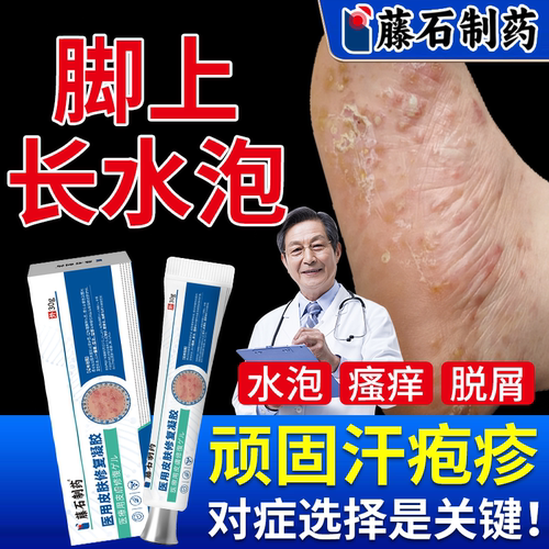 医用级别脚上汗疱疹止痒专用膏