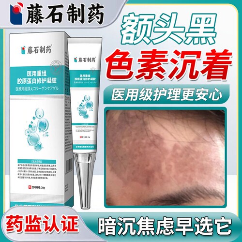 藤石制药额头黑黑色素沉淀去除