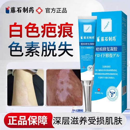 白色疤痕色素脱失儿童可用烧烫疤