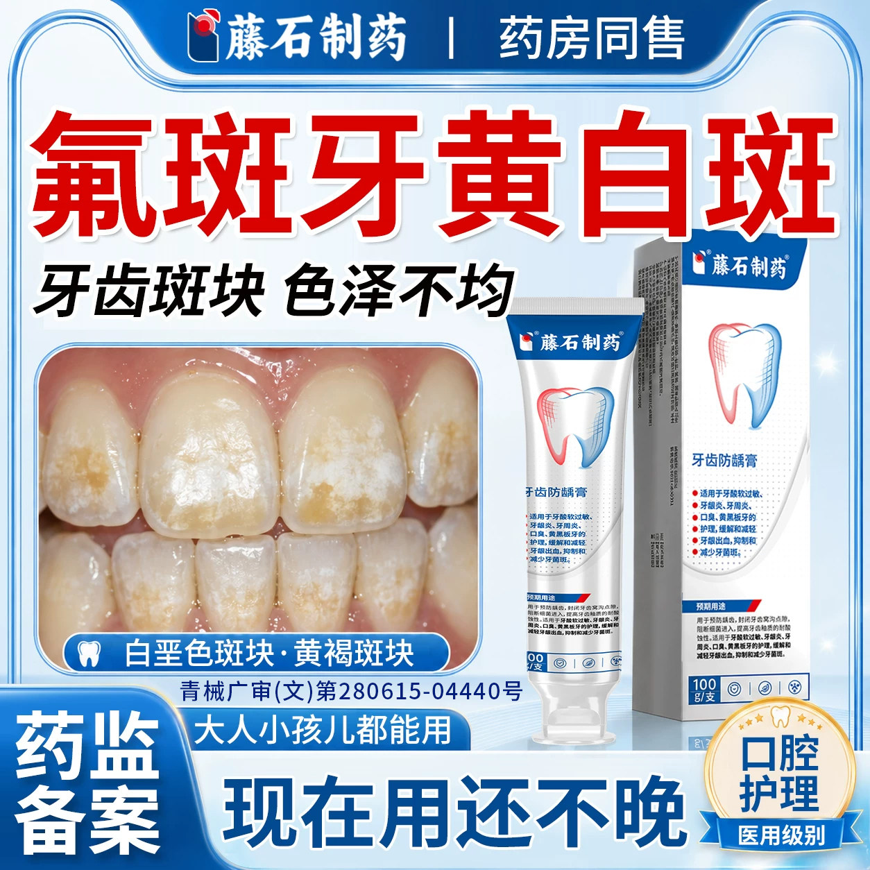 氟斑牙专用去除白斑黄褐色可搭牙膏用儿童牙齿色素沉淀牙菌斑WQ