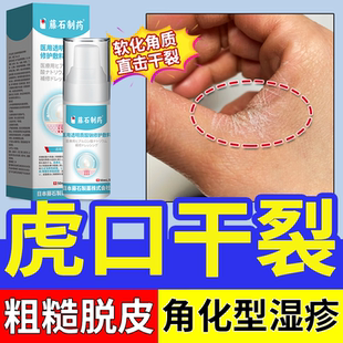 虎口手部角化型干性湿疹脱皮干裂真菌感染角质化性皲裂性手癣膏TU
