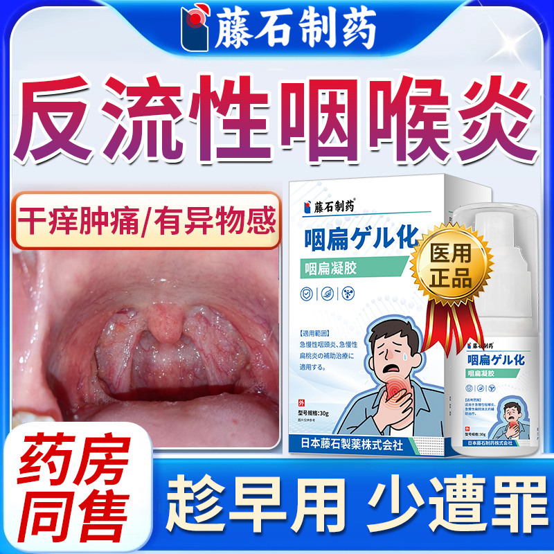 反流性咽喉炎肿痛有异物感