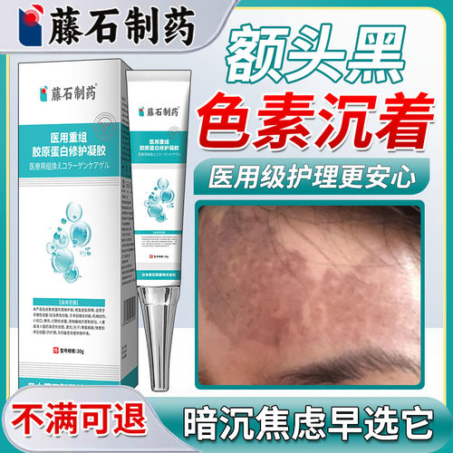 藤石制药额头黑黑色素沉淀去除