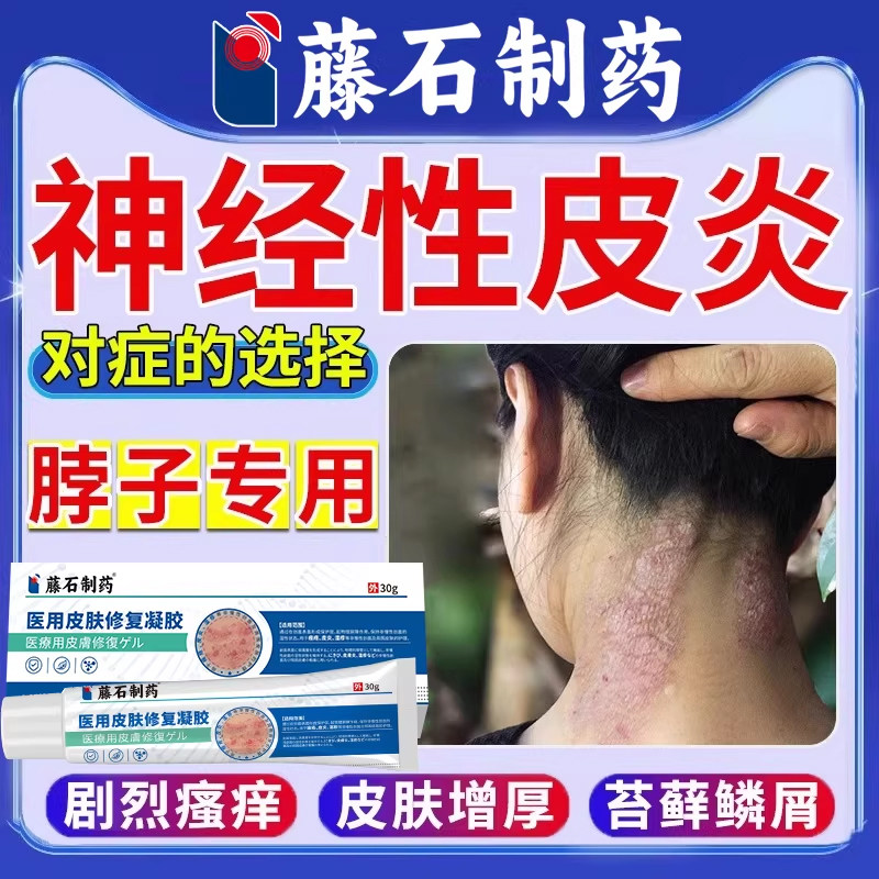 脖子上神经性皮炎瘙痒去祛顽固根长癣痒除止痒喷雾剂贴外用膏WQ