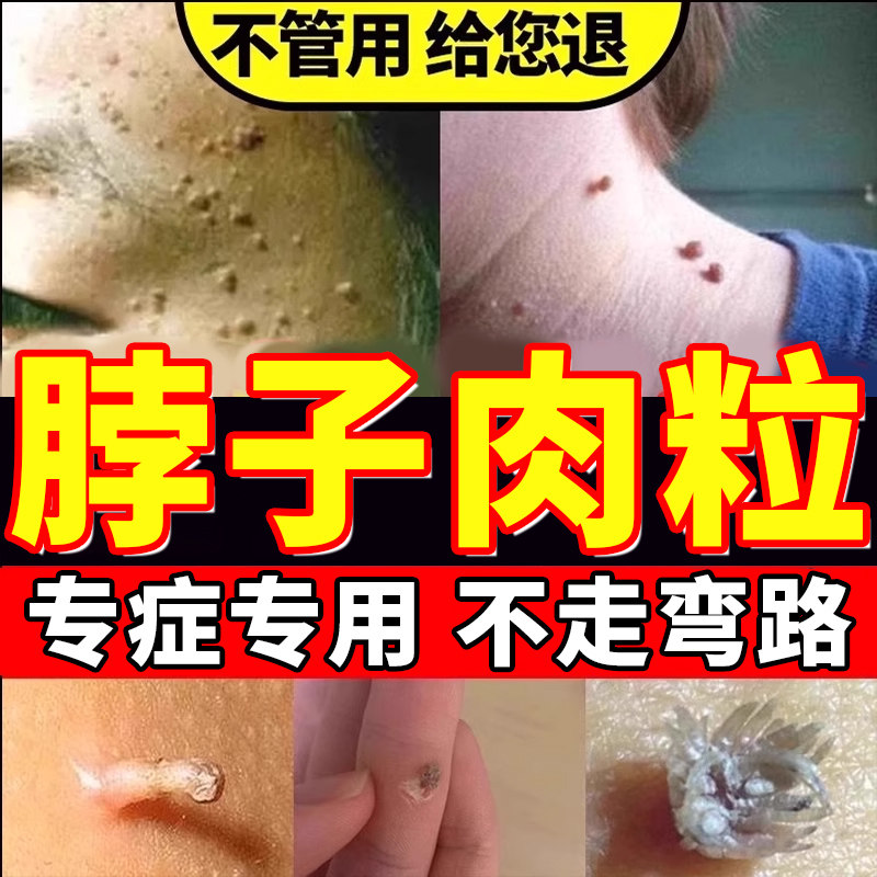 去疣尤瘊脖子上长小肉粒点猴子疙瘩正品扁平疣乳膏可搭配药膏用tu