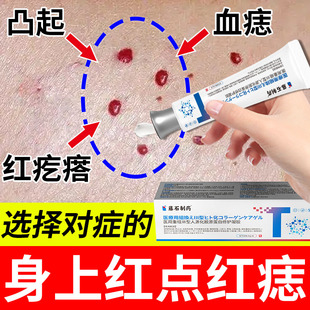 去除血管痣小红点樱桃状血管瘤点红痣蜘蛛痣祛血痣凝胶药房同款TU