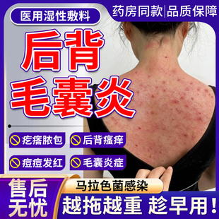 背后长痘痘前胸后背毛囊炎除螨祛痘背发红瘙痒上止痒沐浴露喷雾TU