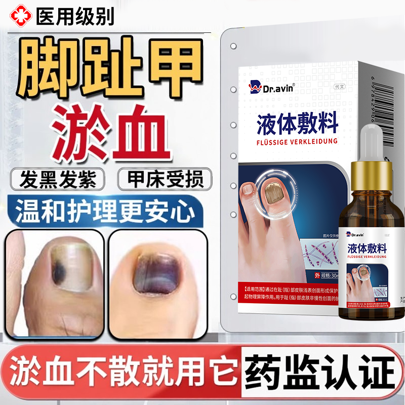 脚趾甲被砸指甲被夹压受损瘀血发黑甲床受伤甲下淤血发紫生长液HT