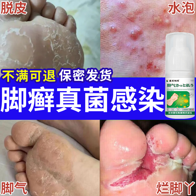 脚癣一扫光止痒去真菌感染