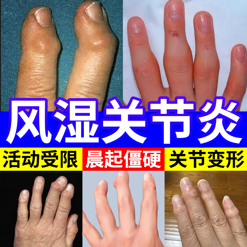 赫伯登结节手指劳损疼痛骨关节炎